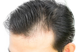 How Light Can Cure Baldness